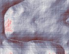symptom atypischer autismus